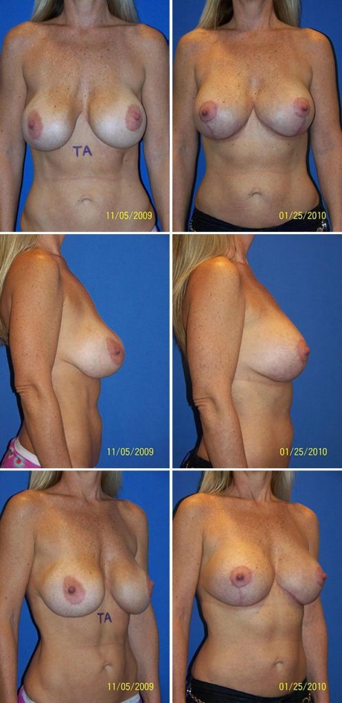 Before and After Image: Breast Augmentation with Lift - other