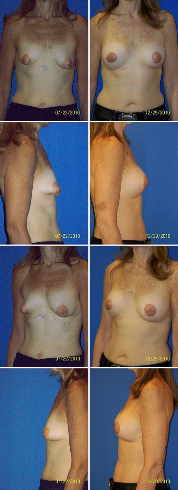 Before and After Image: Breast Augmentation with Lift - other