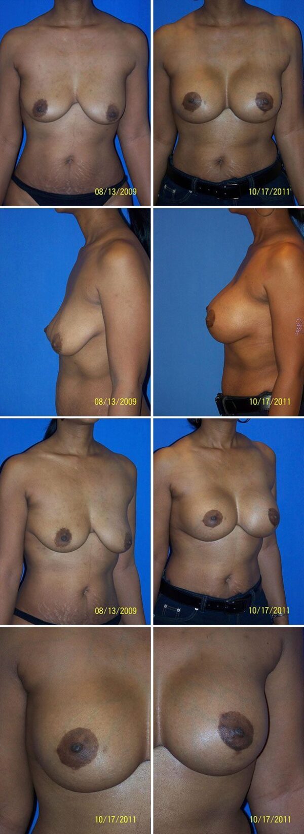 Before and After Image: Breast Augmentation with Lift - other
