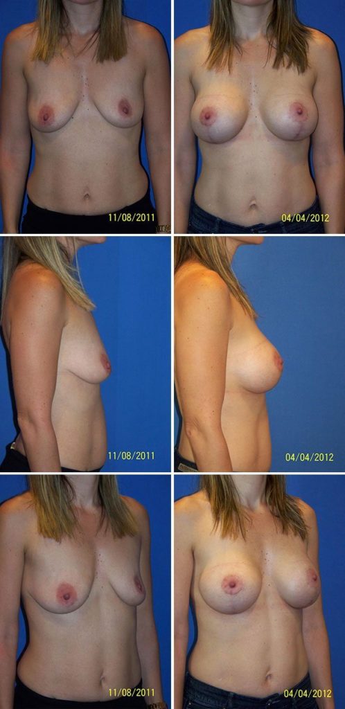 Before and After Image: Breast Augmentation with Lift - other