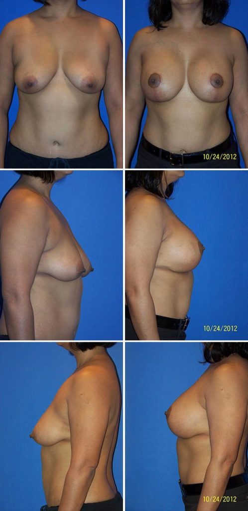 Before and After Image: Breast Augmentation with Lift - other