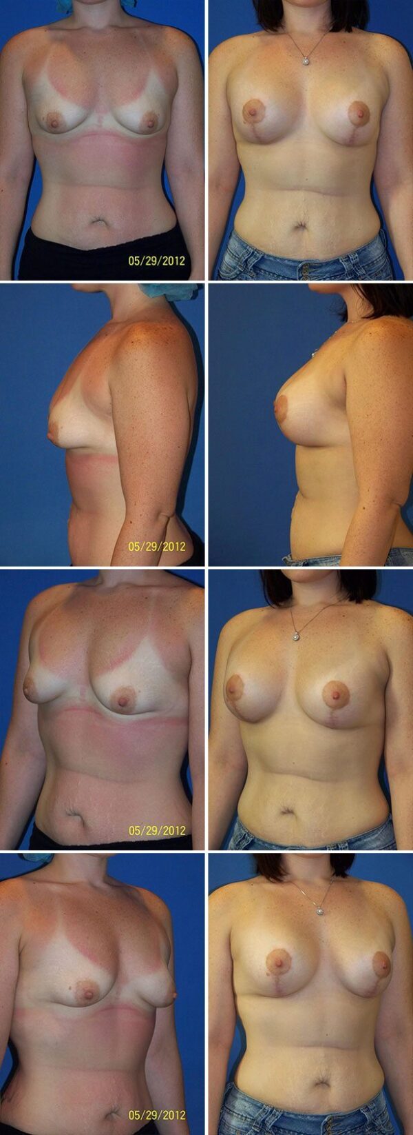 Before and After Image: Breast Augmentation with Lift - other