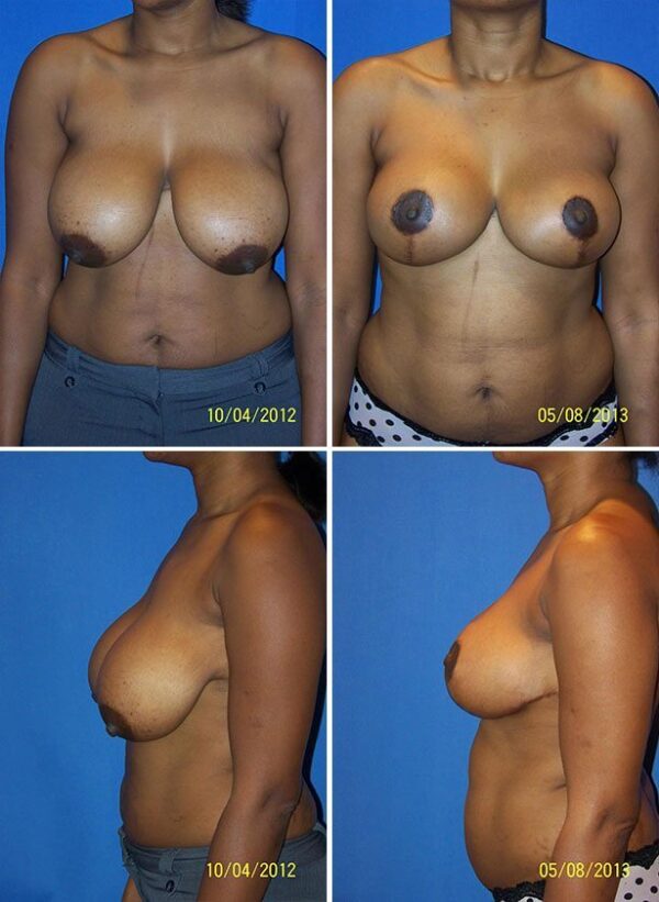 Before and After Image: Breast Augmentation with Lift - other