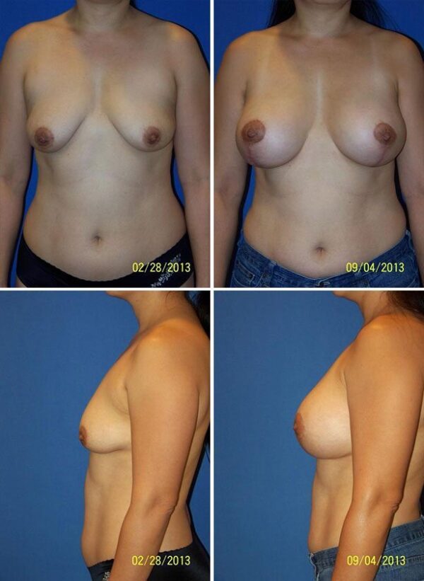 Before and After Image: Breast Augmentation with Lift - other