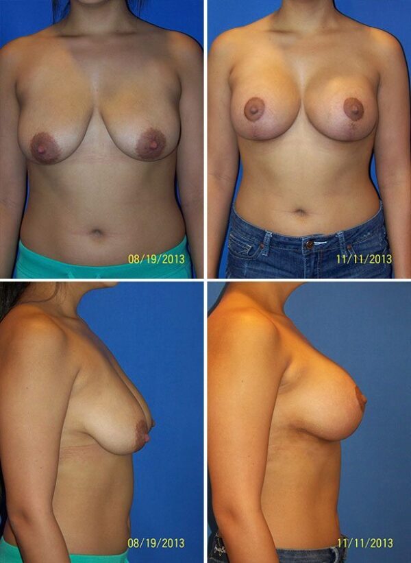 Before and After Image: Breast Augmentation with Lift - other