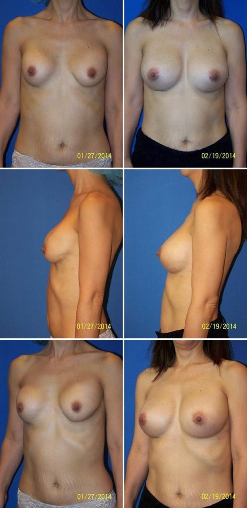 Before and After Image: Breast Implant Revision - other