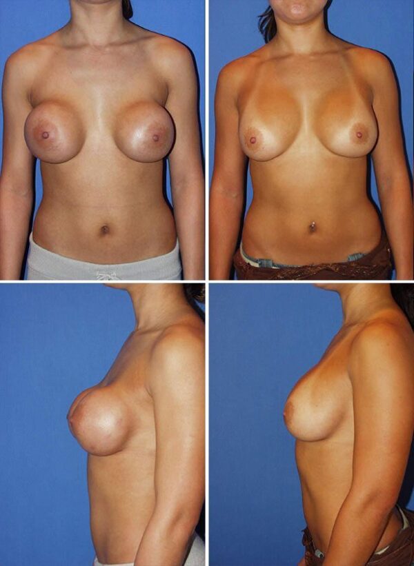 Before and After Image: Breast Implant Revision - other