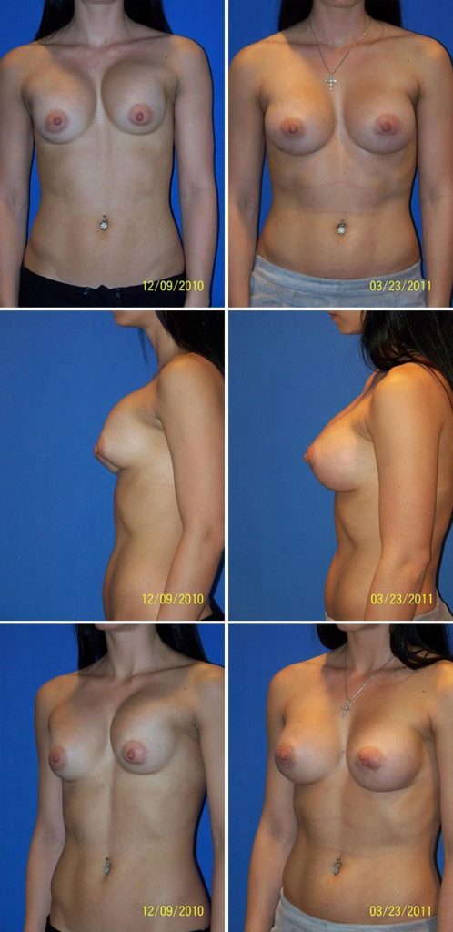 Before and After Image: Breast Implant Revision - other