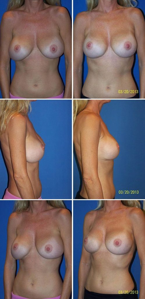 Before and After Image: Breast Implant Revision - other