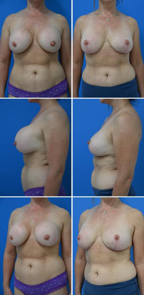 Before and After Image: Breast Implant Revision - other