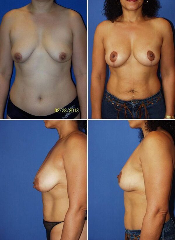 Before and After Image: Breast Lift - other