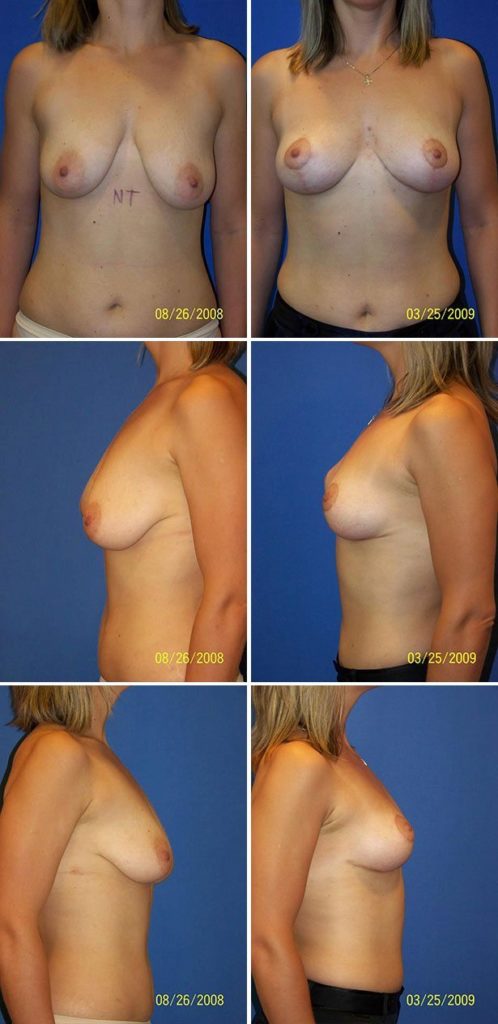 Before and After Image: Breast Lift - other