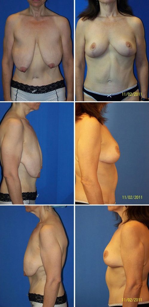 Before and After Image: Breast Lift - other