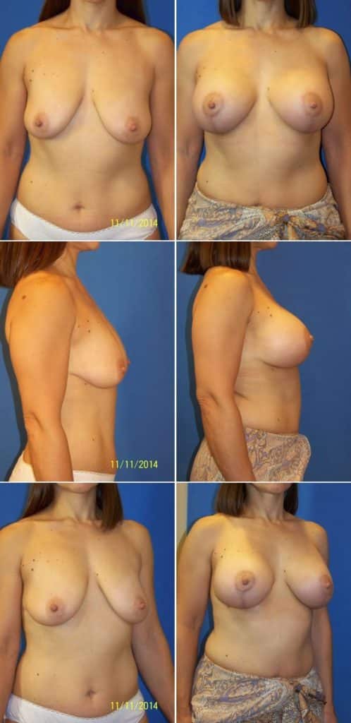 Before and After Image: Breast Augmentation with Lift - other