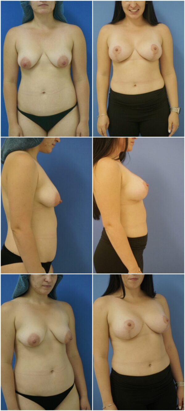 Before and After Image: Breast Augmentation with Lift - other