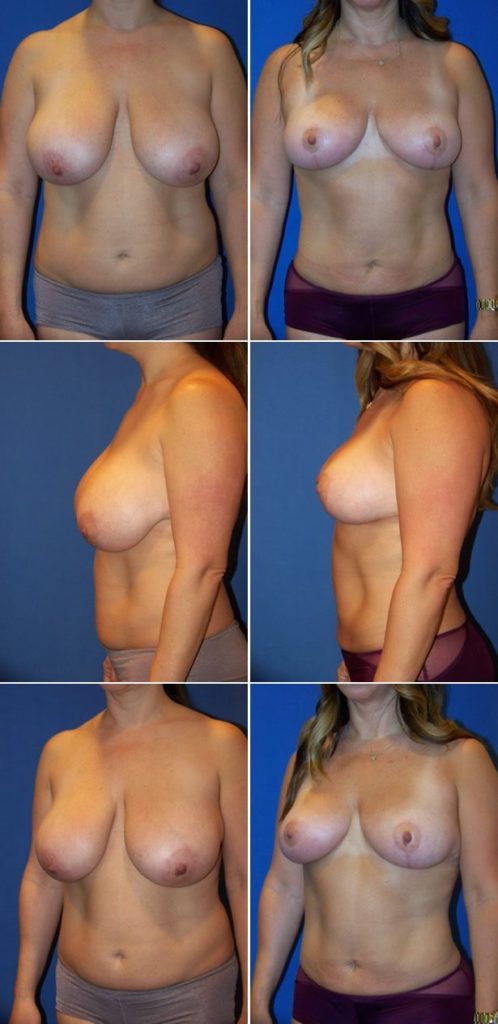 Before and After Image: Breast Reduction Surgery - other