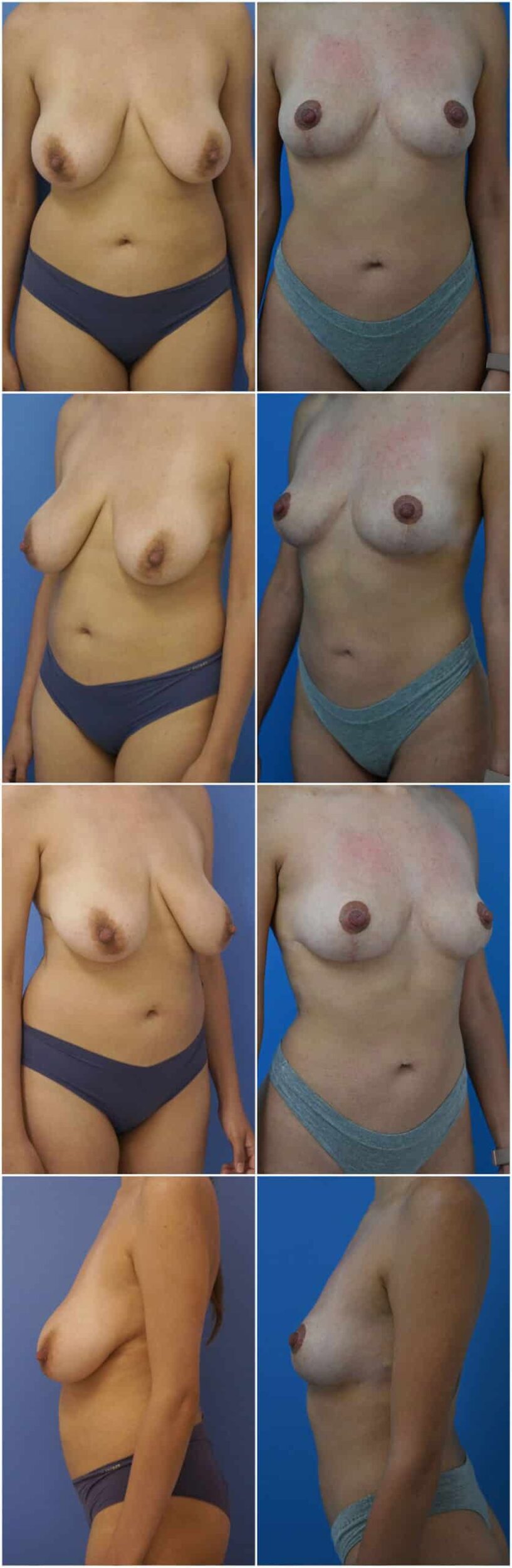 Before and After Image: Breast Reduction Surgery - other
