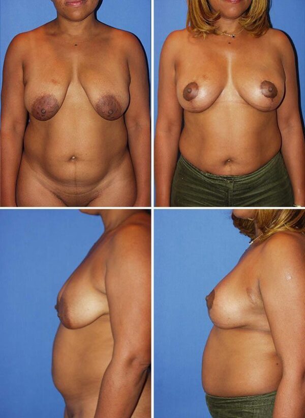 Before and After Image: Breast Reduction Surgery - other