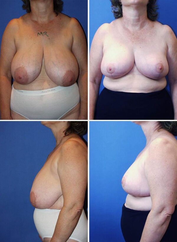 Before and After Image: Breast Reduction Surgery - other