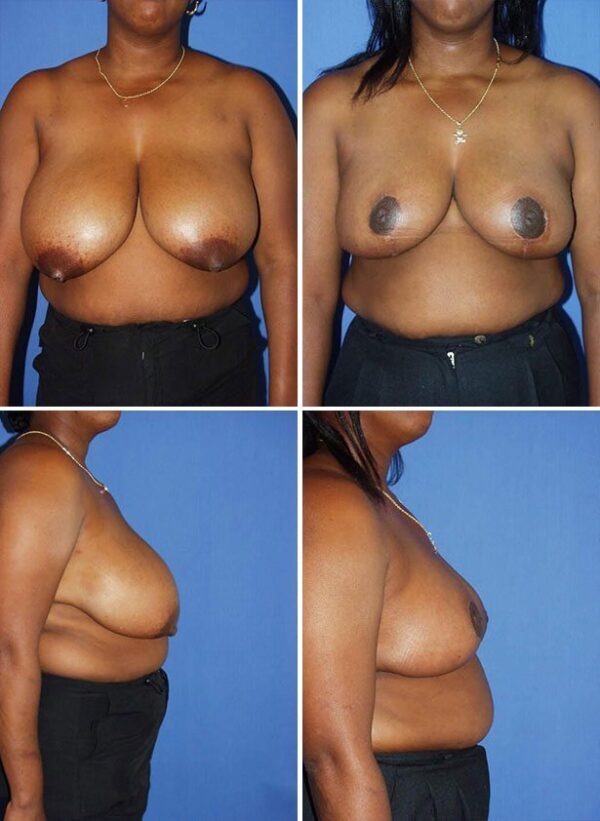Before and After Image: Breast Reduction Surgery - other