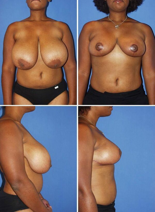 Before and After Image: Breast Reduction Surgery - other