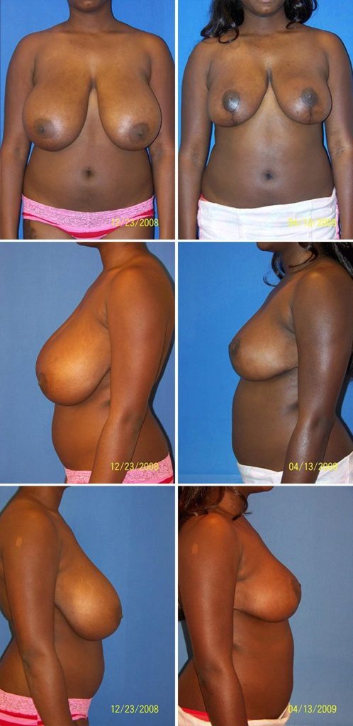 Before and After Image: Breast Reduction Surgery - other