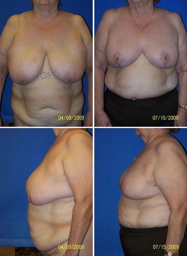 Before and After Image: Breast Reduction Surgery - other