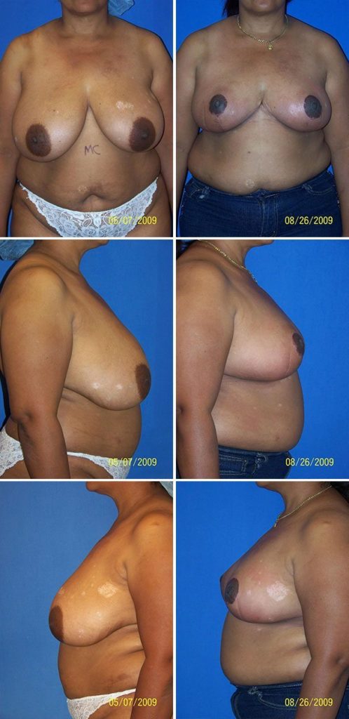 Before and After Image: Breast Reduction Surgery - other
