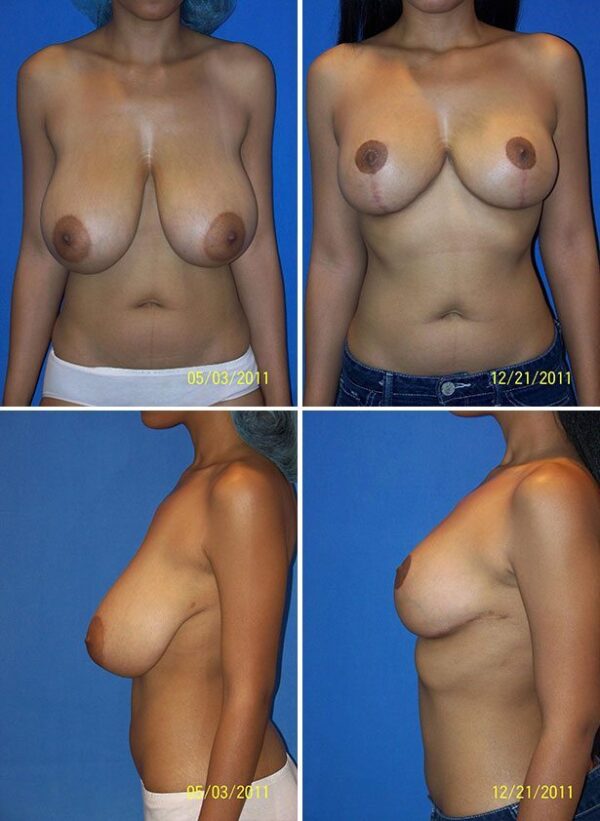 Before and After Image: Breast Reduction Surgery - other