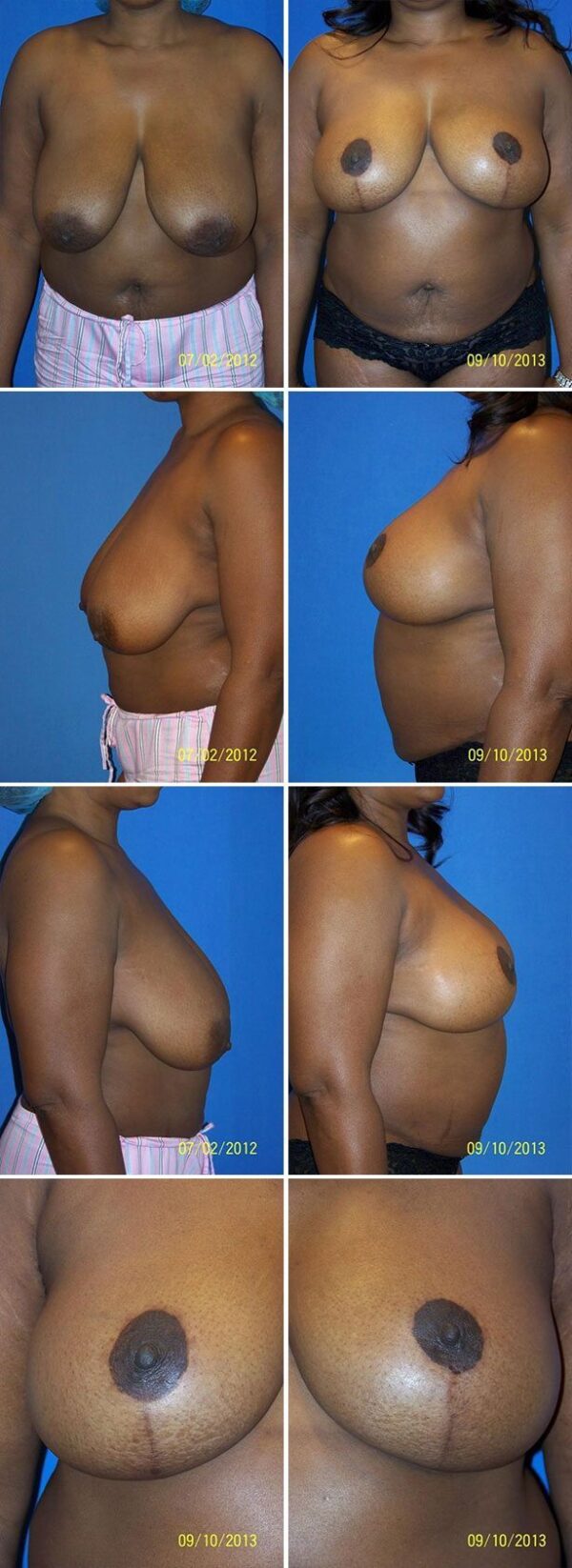 Before and After Image: Breast Reduction Surgery - other