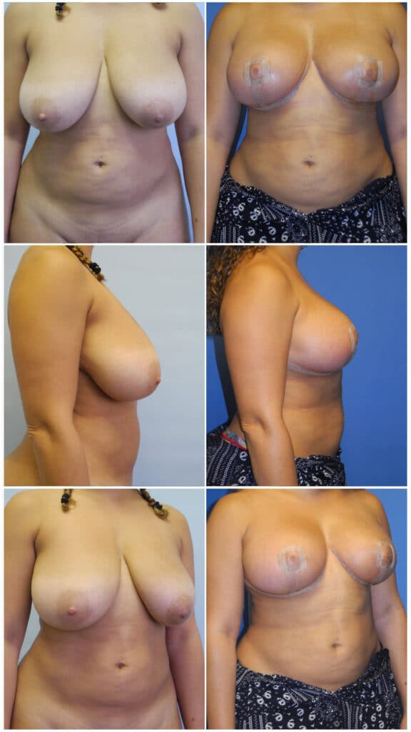 Before and After Image: Breast Reduction Surgery - other