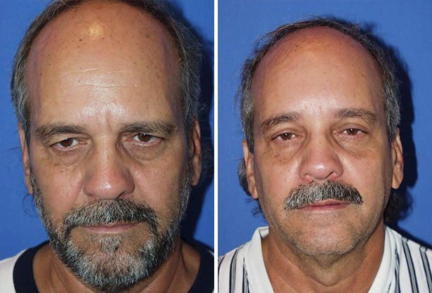 Before and After Image: Brow Lift (Forehead Lift) Surgery - front
