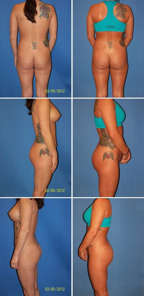 Before and After Image: Butt Augmentation (Implants) - other