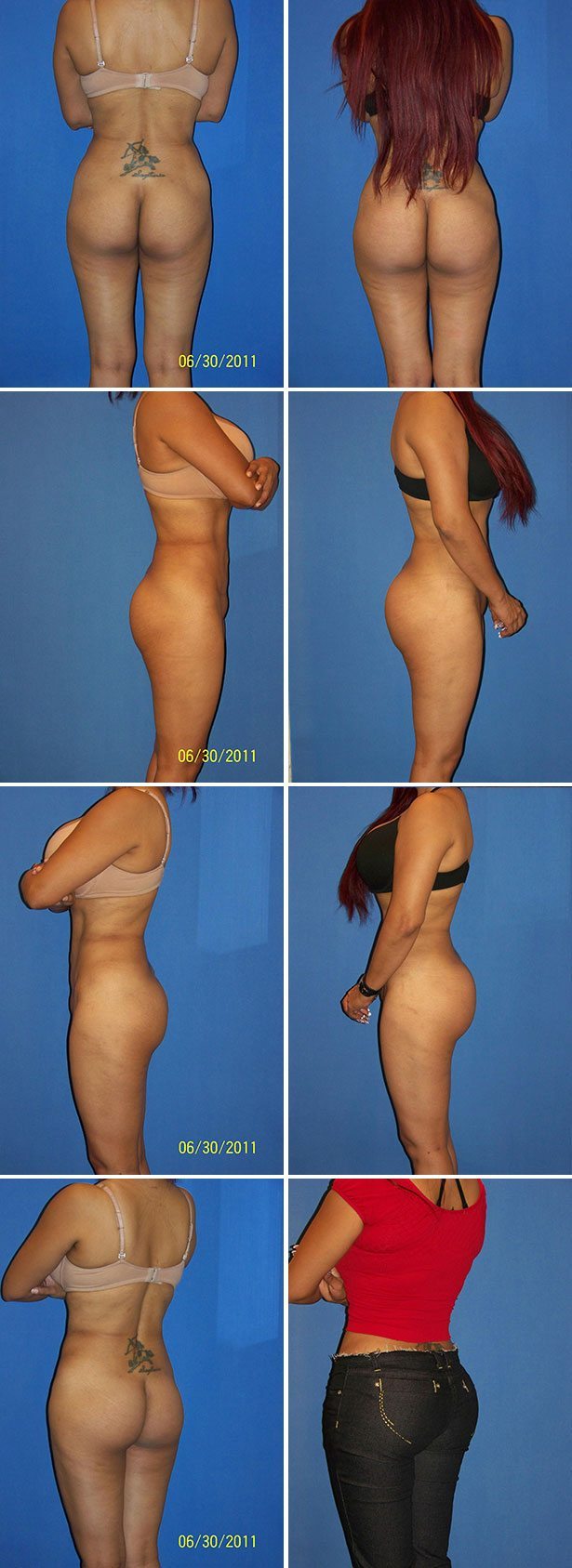 Before and After Image: Butt Augmentation (Implants) - other