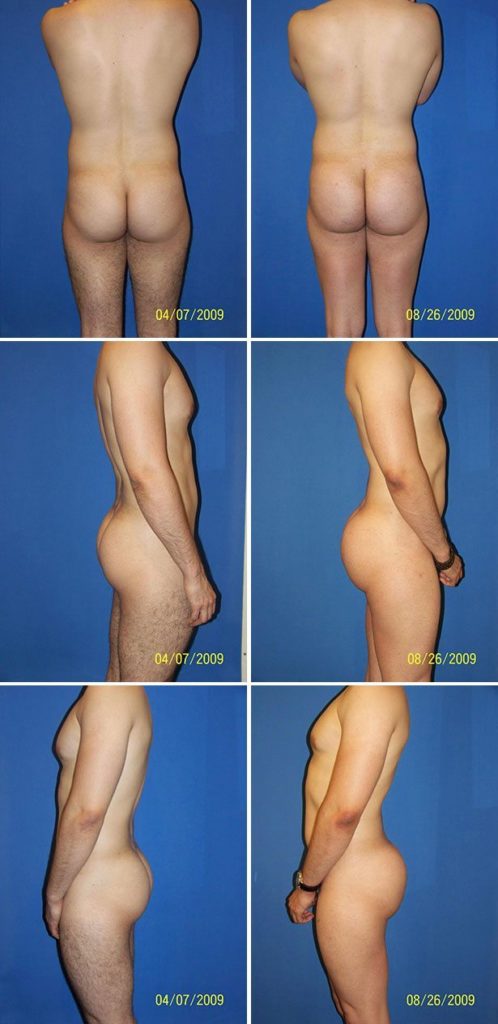 Before and After Image: Butt Augmentation (Implants) - other