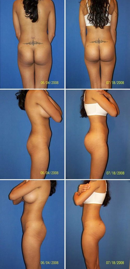 Before and After Image: Butt Augmentation (Implants) - other