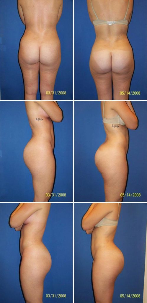Before and After Image: Butt Augmentation (Implants) - other