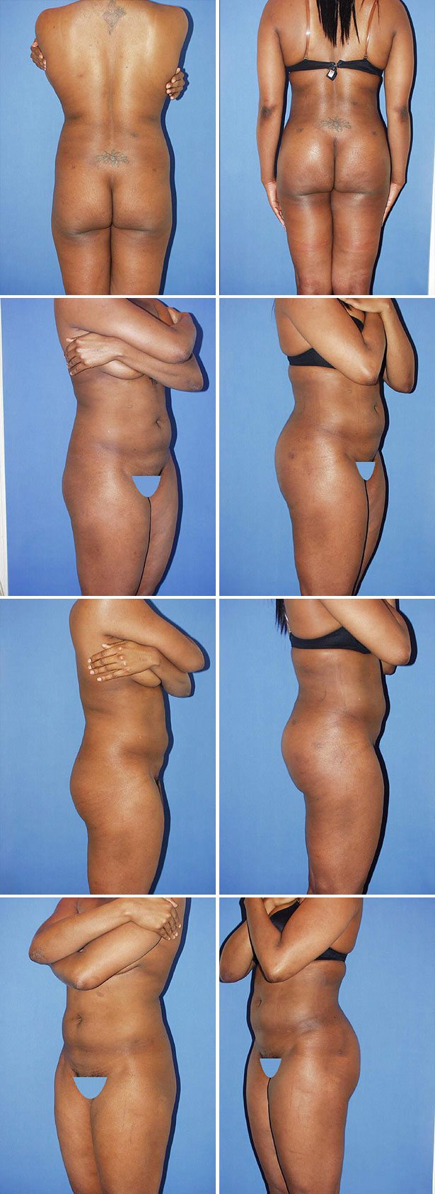 Before and After Image: Butt Augmentation (Implants) - other