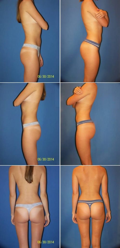 Before and After Image: Butt Augmentation (Implants) - other