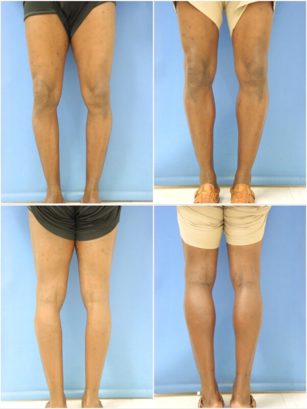 Before and After Image: Calf Augmentation - other