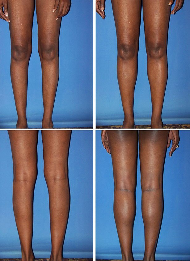 Before and After Image: Calf Augmentation - other