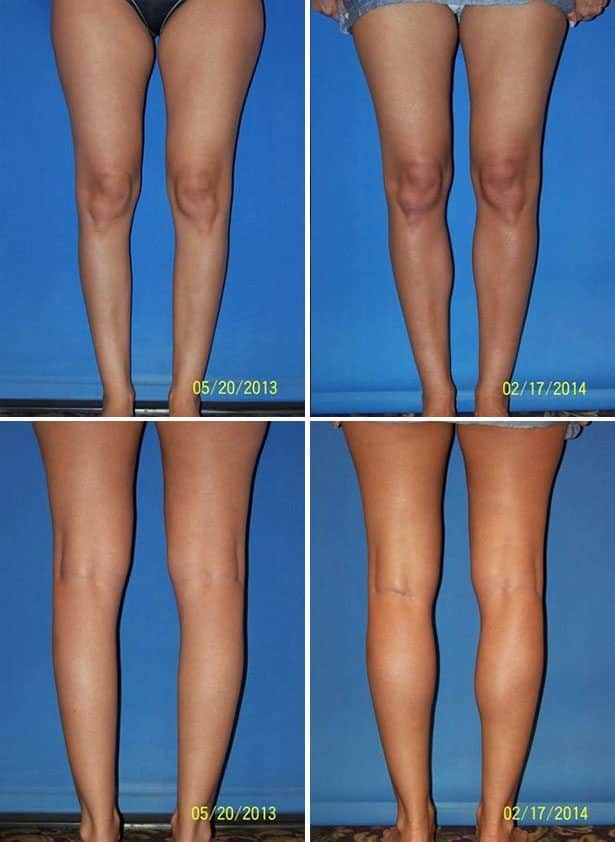 Before and After Image: Calf Augmentation - other
