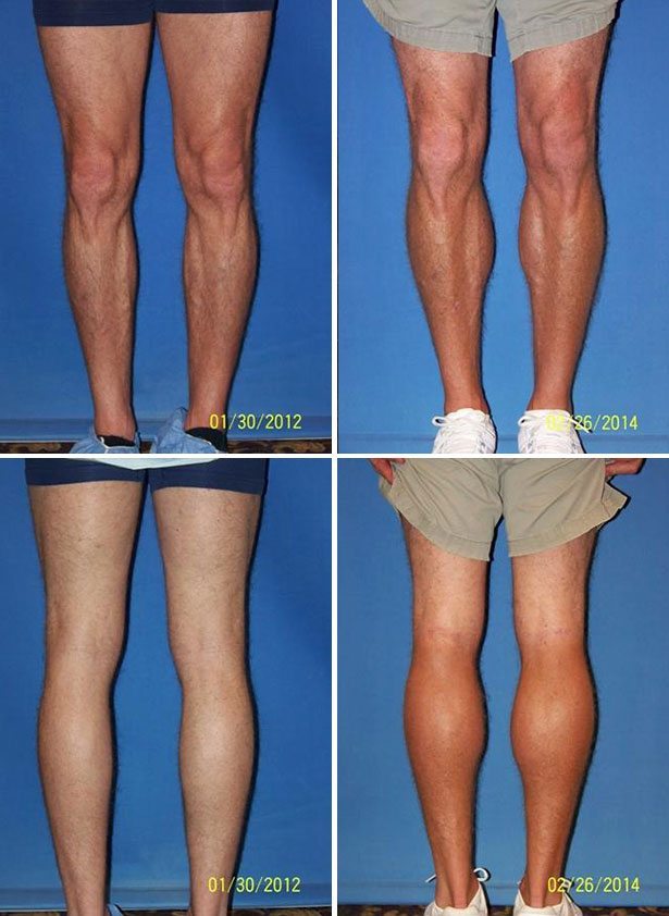 Before and After Image: Calf Augmentation - other