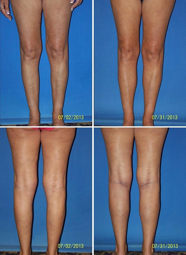 Before and After Image: Calf Augmentation - other