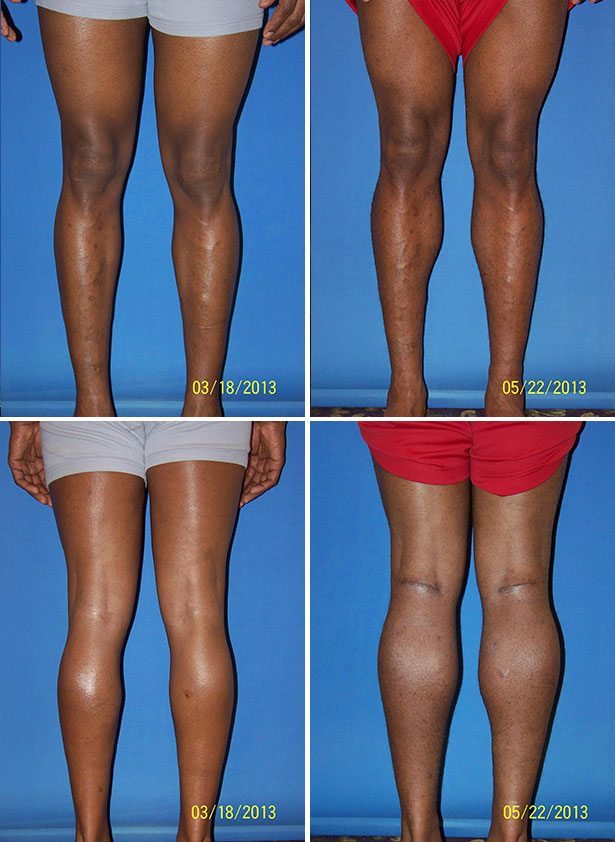 Before and After Image: Calf Augmentation - other