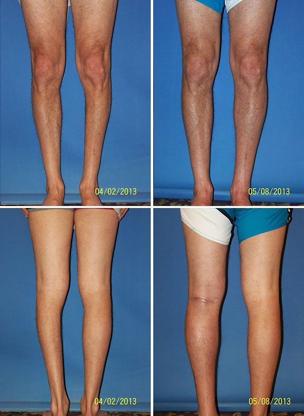 Before and After Image: Calf Augmentation - other