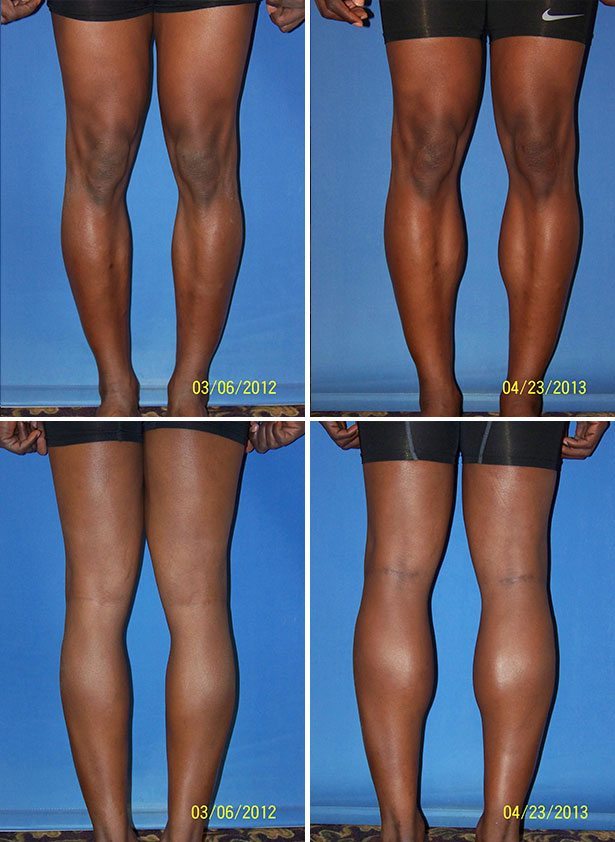 Before and After Image: Calf Augmentation - other