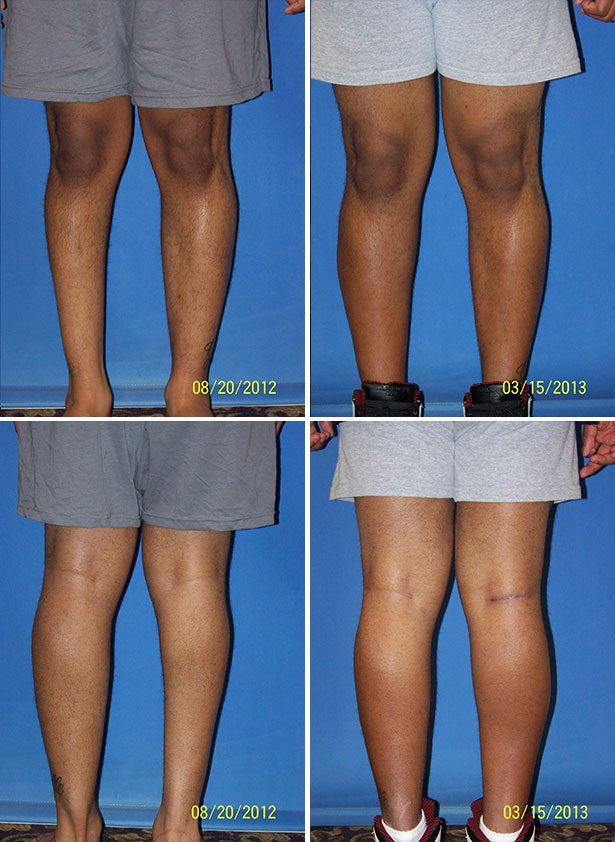 Before and After Image: Calf Augmentation - other