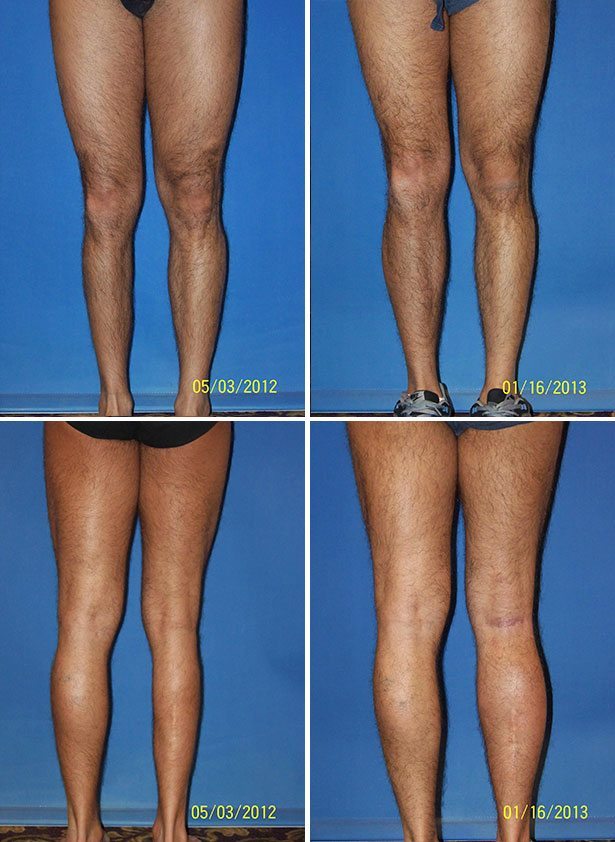 Before and After Image: Calf Augmentation - other