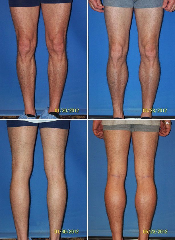 Before and After Image: Calf Augmentation - other